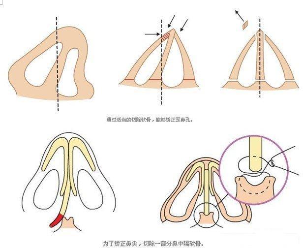 自体软骨隆鼻 .jpg